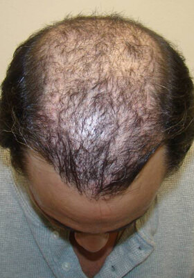 hair transplant before after Photos