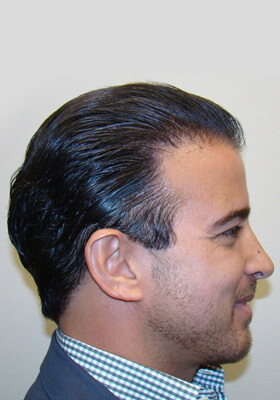 hair transplant photos