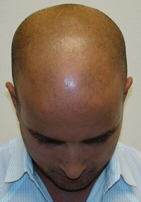 hair transplant photos