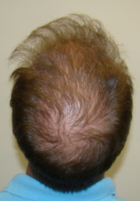 hair transplant photos