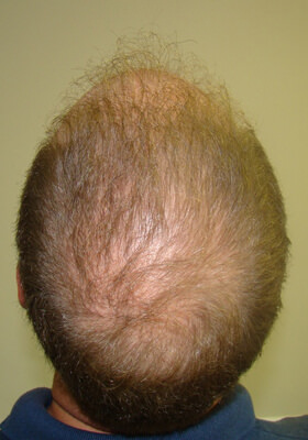 hair transplant before after Photos