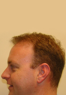 hair transplant photos