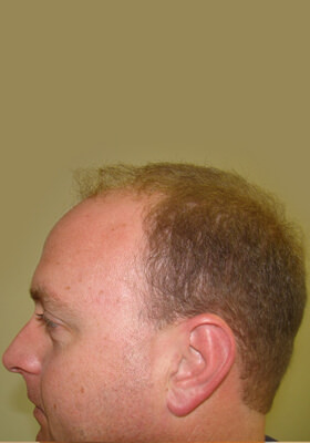 hair transplant before after Photos