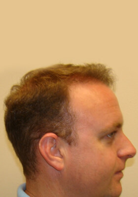 hair transplant before after Photos