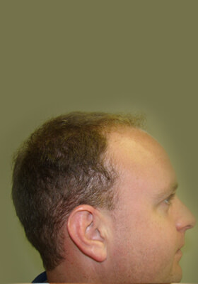 hair transplant before after Photos