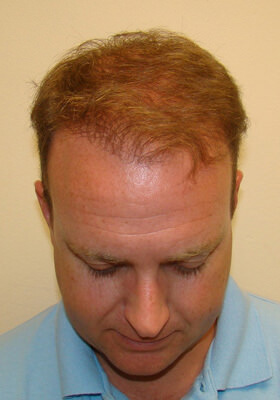 hair transplant before after Photos