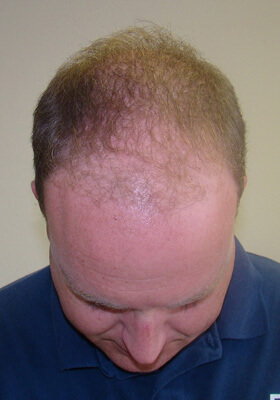 hair transplant before after Photos