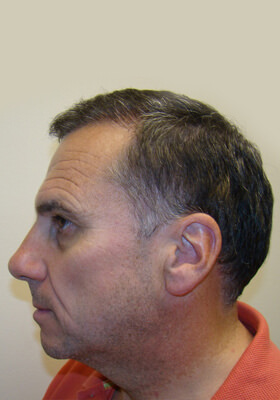 hair transplant photos