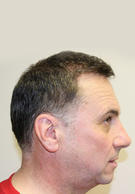 hair transplant photos