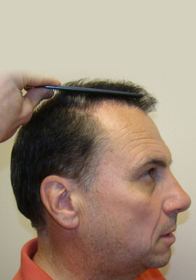 hair transplant photos