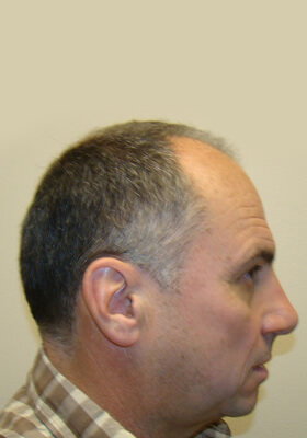 hair transplant before after Photos