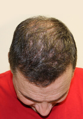 hair transplant before after Photos