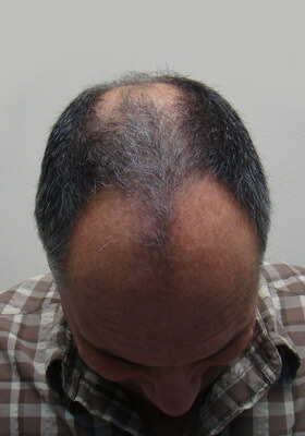 hair transplant before after Photos