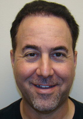 hair transplant photos