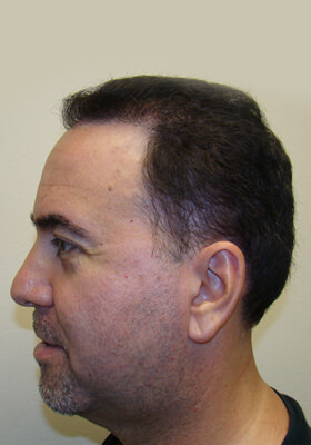 hair transplant before after Photos