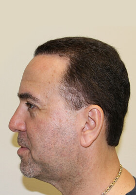 hair transplant photos