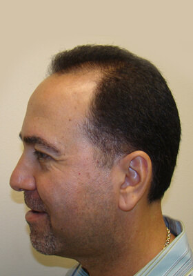 hair transplant before after Photos