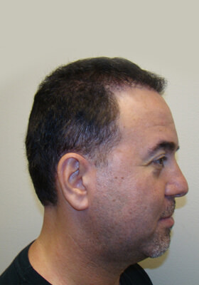 hair transplant before after Photos