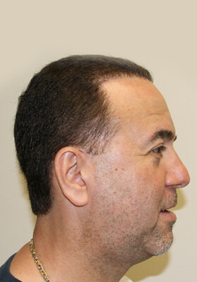 hair transplant before after Photos