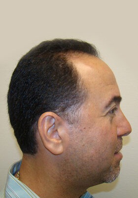 hair transplant photos