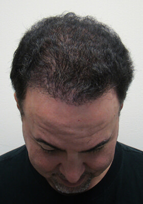 hair transplant before after Photos