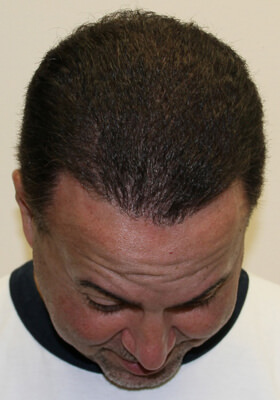 hair transplant photos