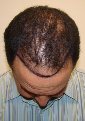 hair transplant before after Photos