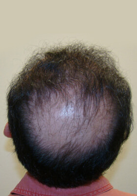 hair transplant photos