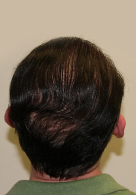 hair transplant photos