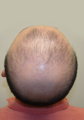 hair transplant before after Photos