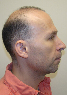Dr Brett Bolton Patient Testimonial Photos - Two Procedures