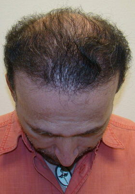 hair transplant before after Photos