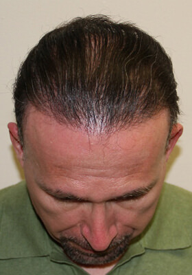 hair transplant photos