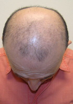 hair transplant before after Photos