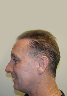 hair transplant before after Photos