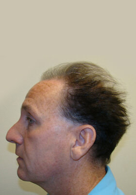 hair transplant before after Photos