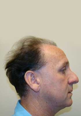 hair transplant before after Photos