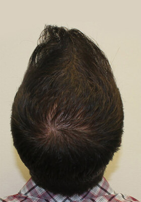 hair transplant before after Photos