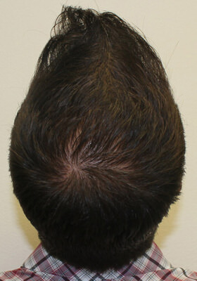 hair transplant photos