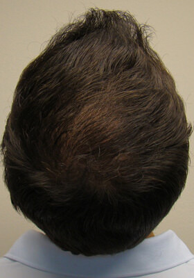 hair transplant photos