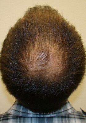 hair transplant before after Photos