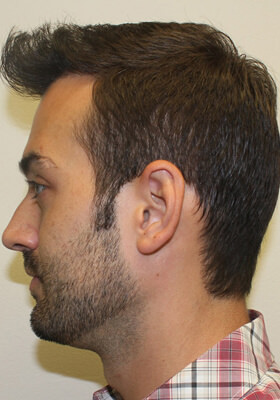 hair transplant photos