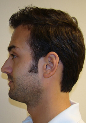 hair transplant photos