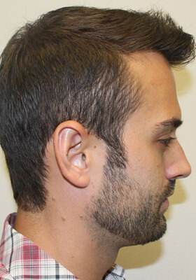 hair transplant photos