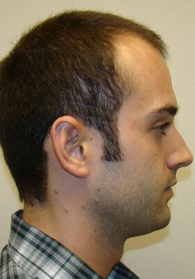 hair transplant photos