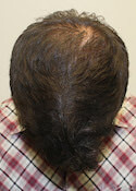 hair transplant before after Photos