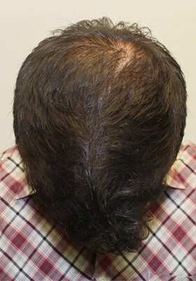 hair transplant before after Photos