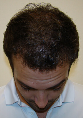 hair transplant photos