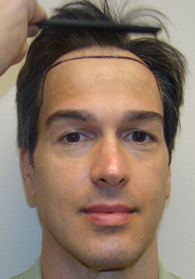 hair transplant photos