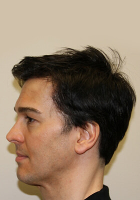 hair transplant photos